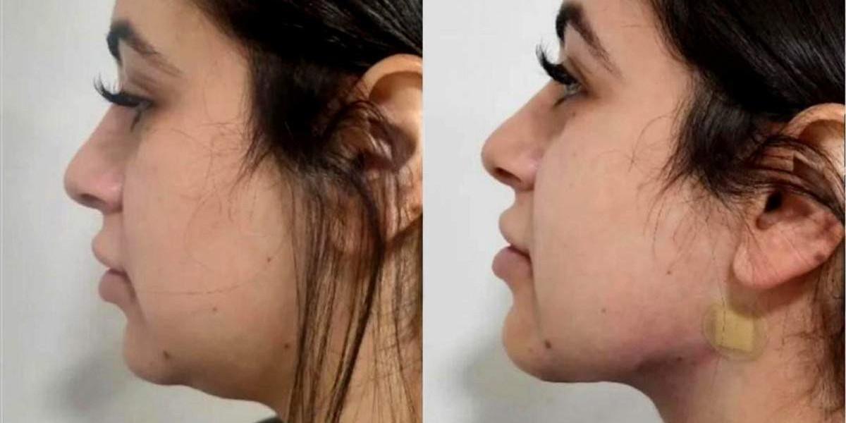 Confidence Booster: Chin Lipo Treatment in Islamabad