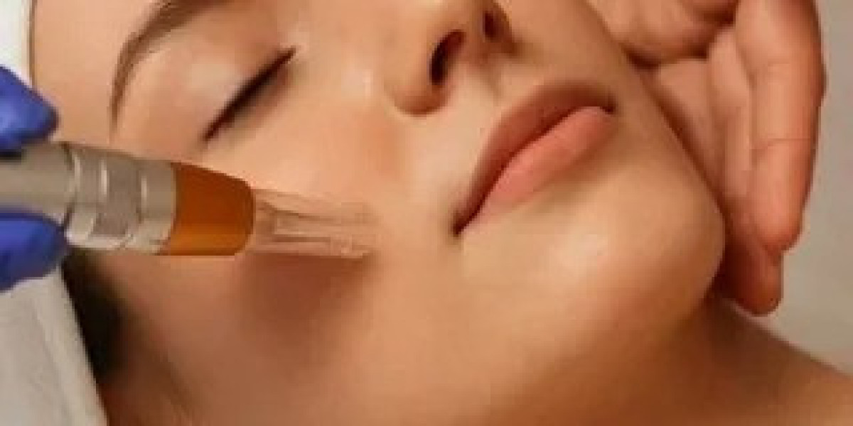 Glow Like Never Before with Chemical Peel Treatment in Islamabad at Enfield Royal Clinic in Islamabad.