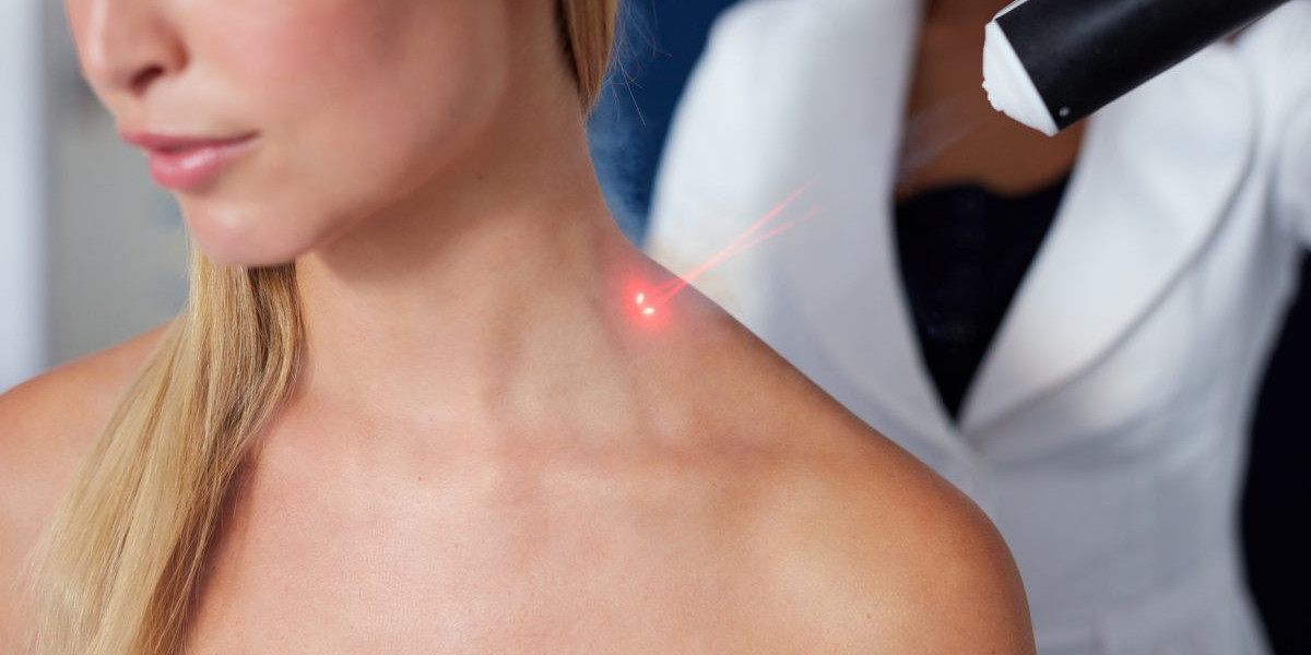 What is the Average Skin Wart Removal Cost in Dubai?