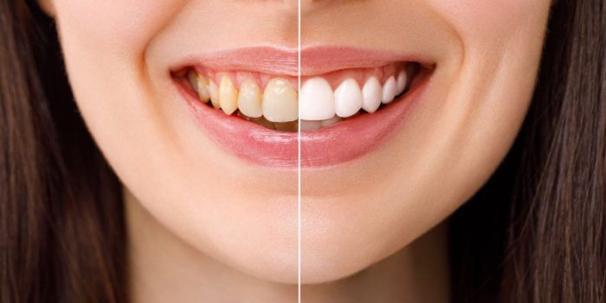 Teeth Whitening Cost Explained: What Impacts the Price?