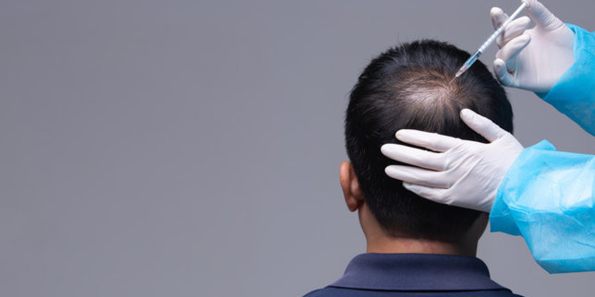 Best Hair Loss Treatment in Islamabad – Enfeild Royal Clinic