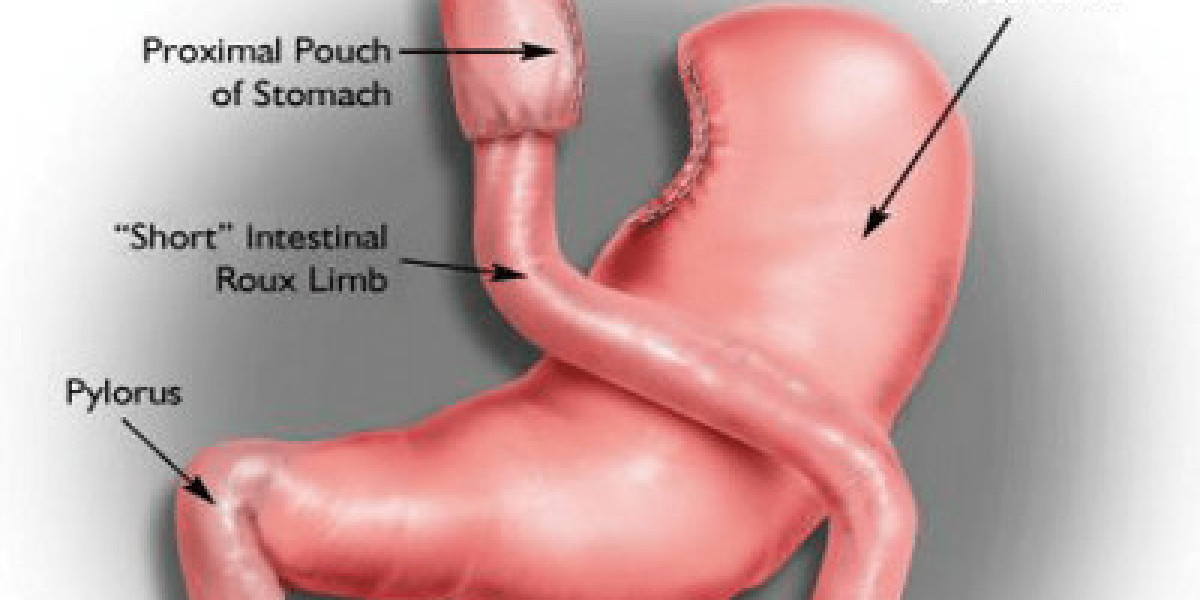 Gastric Bypass – Trusted Medical Procedure for Effective Weight Loss Results
