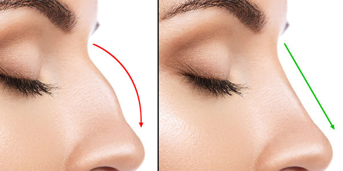 Step Into Confidence with Rhinoplasty in Dubai Solutions