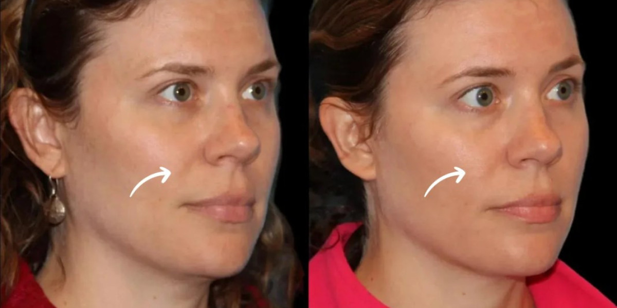 Sculptra Hydration Boost at Best Aesthetic Clinics in Dubai