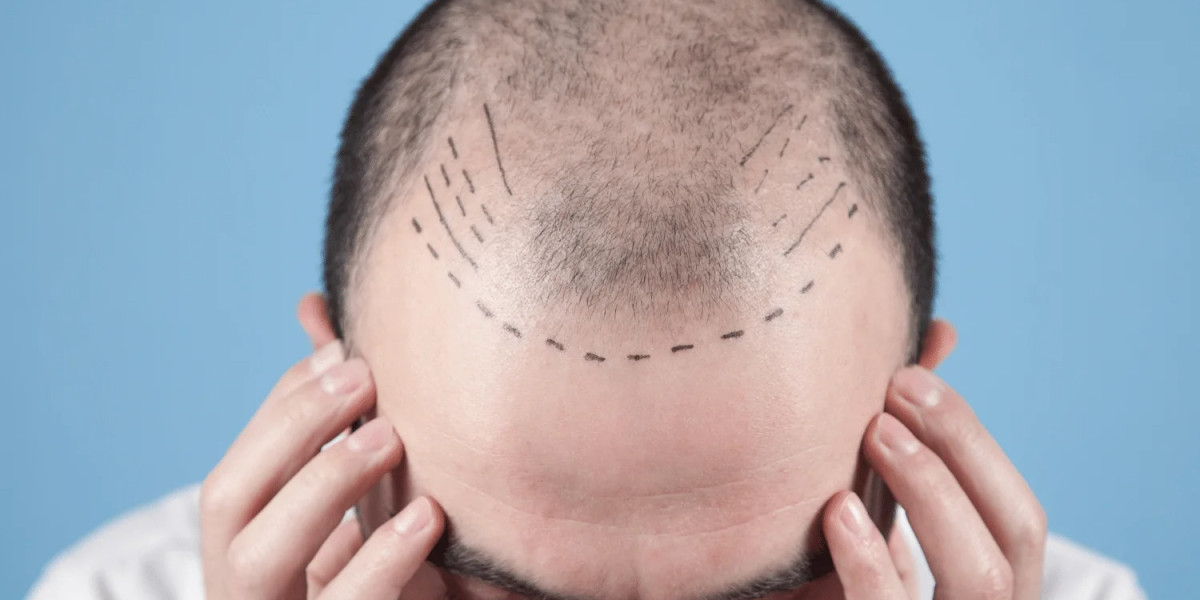 How Long Does a Hair Transplant in Dubai Take to Show Results?