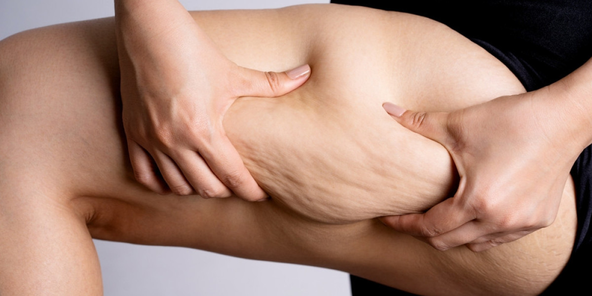 Surgical vs Non-Surgical Lipedema Treatment: Which Is Right for You?