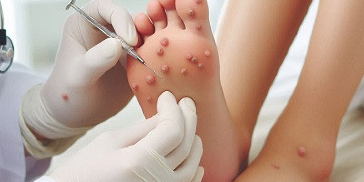 Wart Removal Services in Your Area