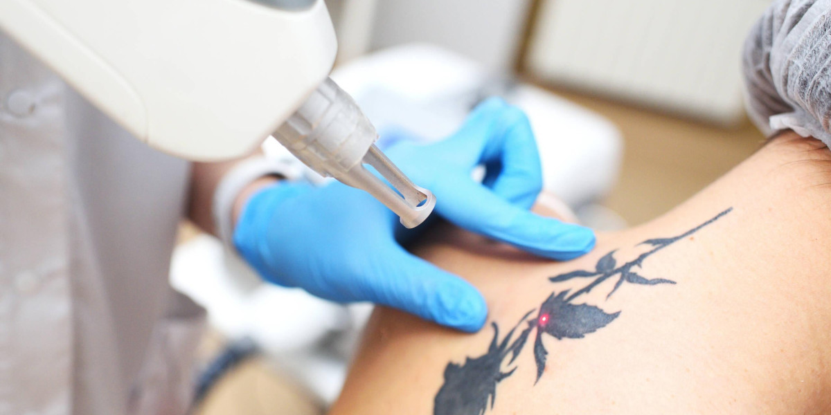 How Tattoo Removal Services Work for Clear Skin Results