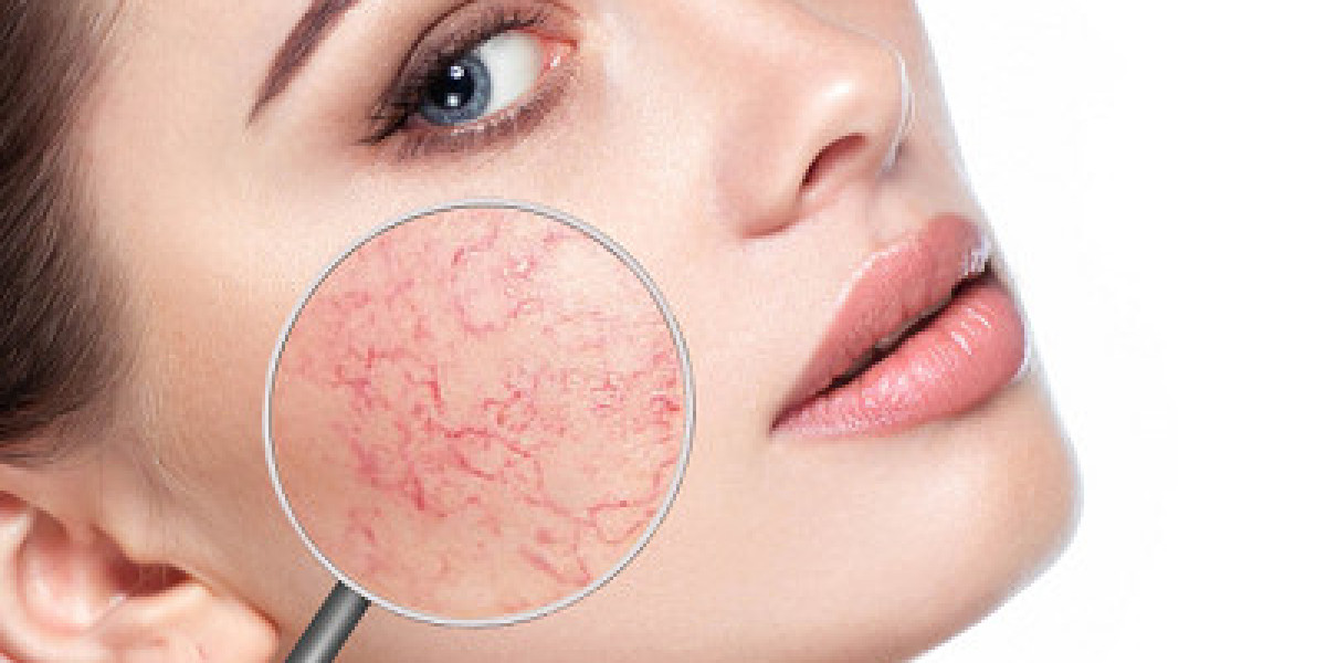 Why Rosacea Treatment in Islamabad is Gaining Popularity