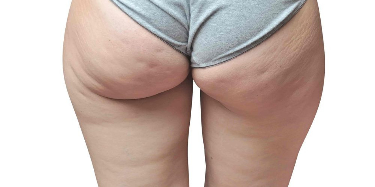 How Effective Is Cellfina Treatment for Cellulite?