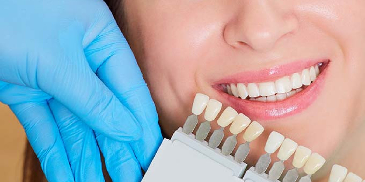 How Porcelain Veneers Help Achieve a Hollywood Smile