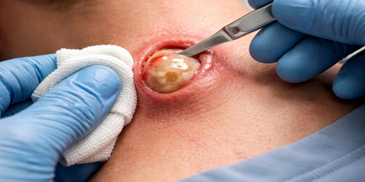 Instant Mole Removal Solutions in Islamabad – Here’s Why