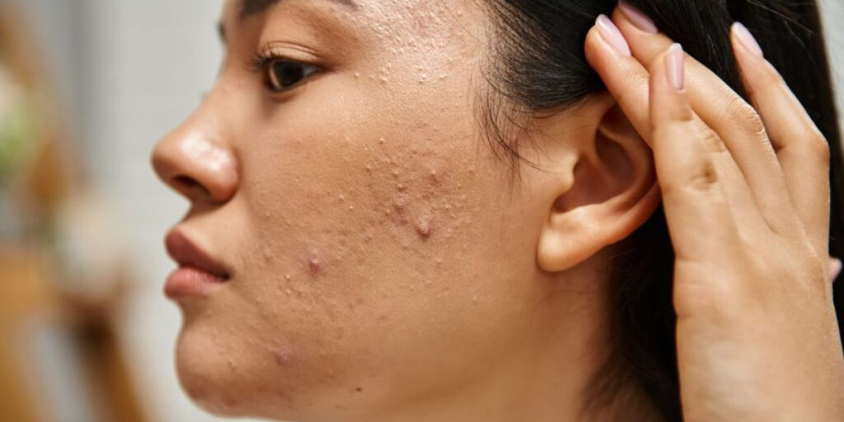 Can Laser Hair Removal Cause Acne or Breakouts?