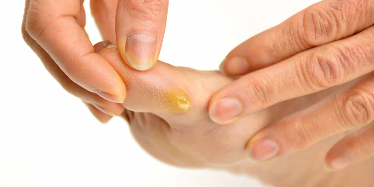 Diabetic Foot Care at Home in Dubai Home Tips