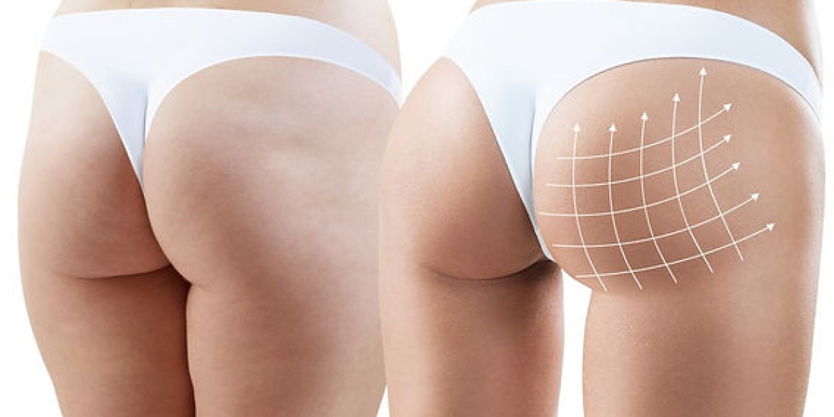 Butt and Body Fillers Approaches That Everyone Is Talking About
