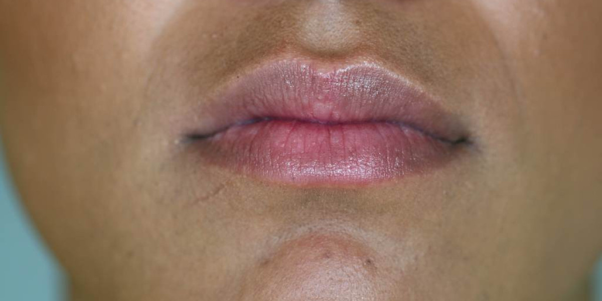 Laser Treatment for Smoker’s Lips: What You Need to Know