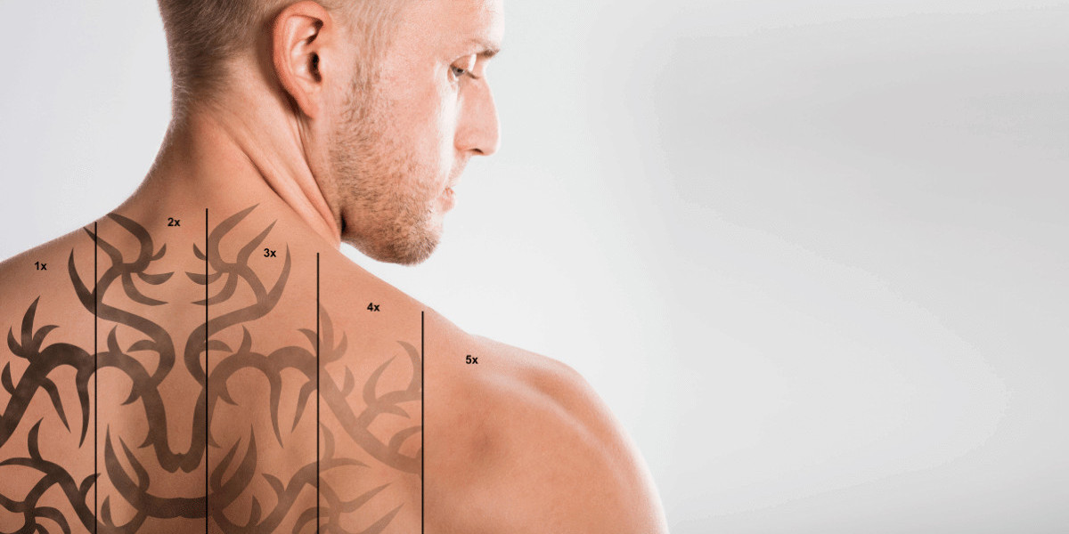 PicoSure Tattoo Removal for Old vs New Tattoos