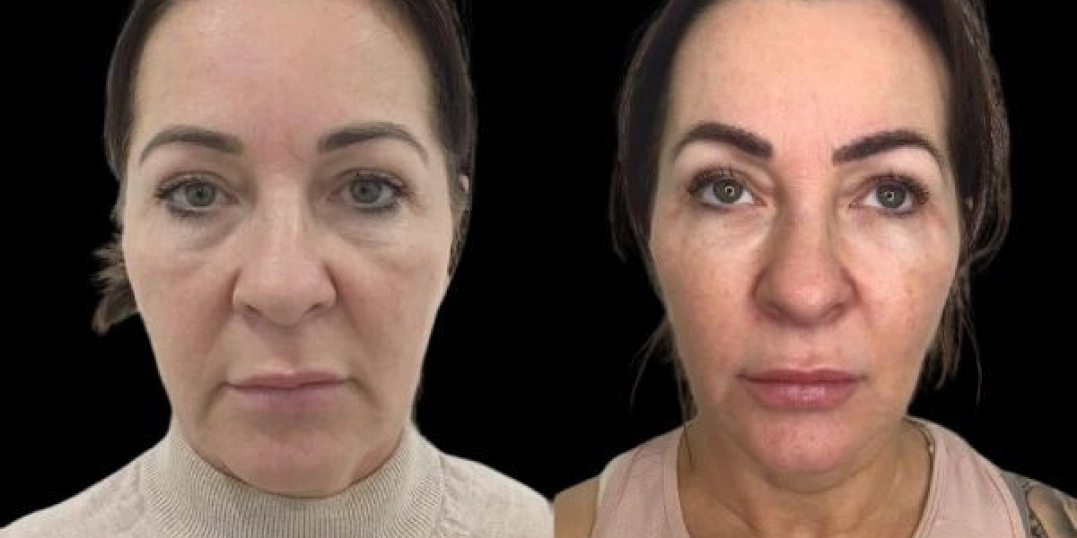 Best Plastic Surgeons in Dubai Explaining Profhilo Skin Benefits
