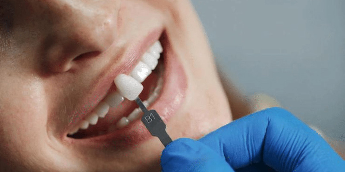 Can Composite Veneers Replace Braces?