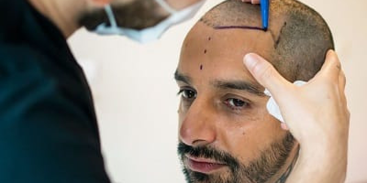 Best Hair Transplant in Islamabad – A Reliable Solution for Hair Loss.
