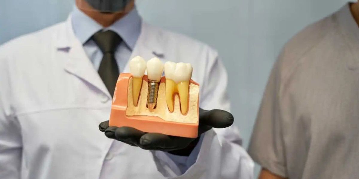 Understanding the True Value Behind Dental Implants in Mississauga