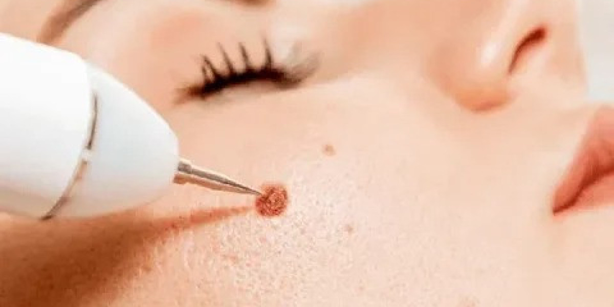 Mole Removal Treatment in Islamabad – Professional and Safe Care at Enfield Royal Clinic Islamabad.