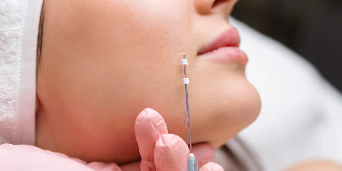 Comparing Thread Lift Materials: PDO vs PLLA vs PCL