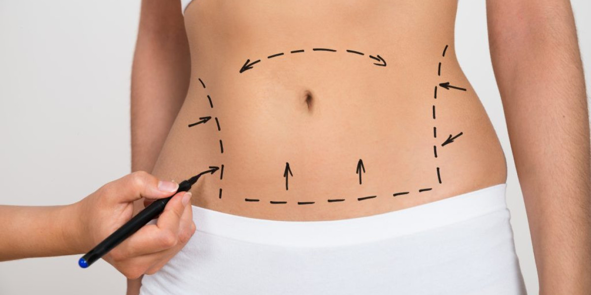 Liposuction in Islamabad – Contour with Confidence