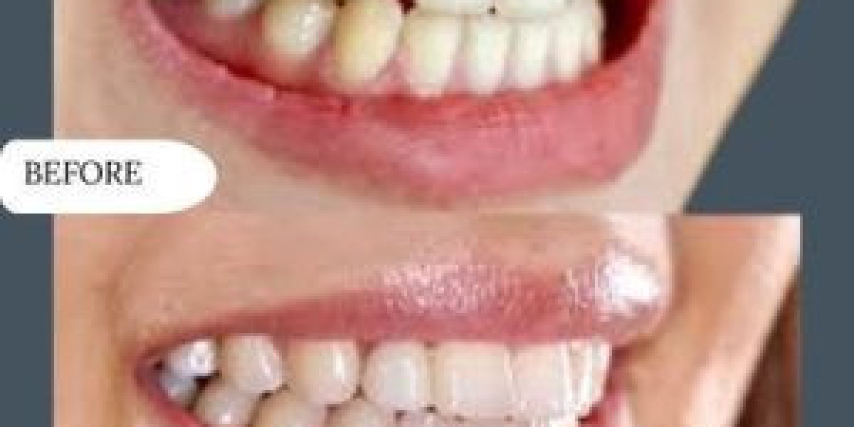 Dental Implants: The Trusted Choice for Restoring Missing Teeth