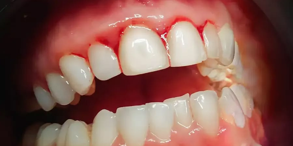 Gum Grafting in Islamabad: When and Why You Need It