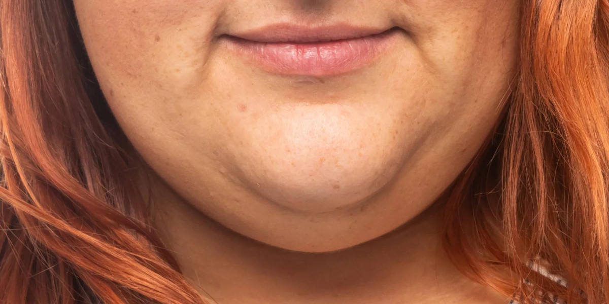 How does Kybella Treatment For Double Chin refine face look?