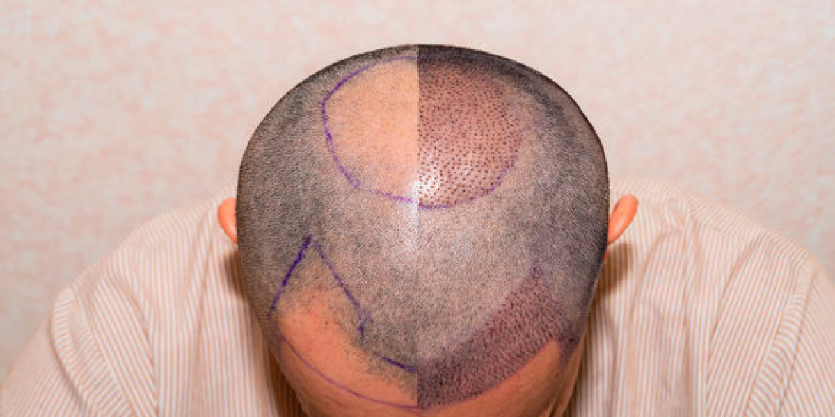 دليلك المالي لعملية زراعة الشعر في دبي: من الاستشارة إلى النتائج