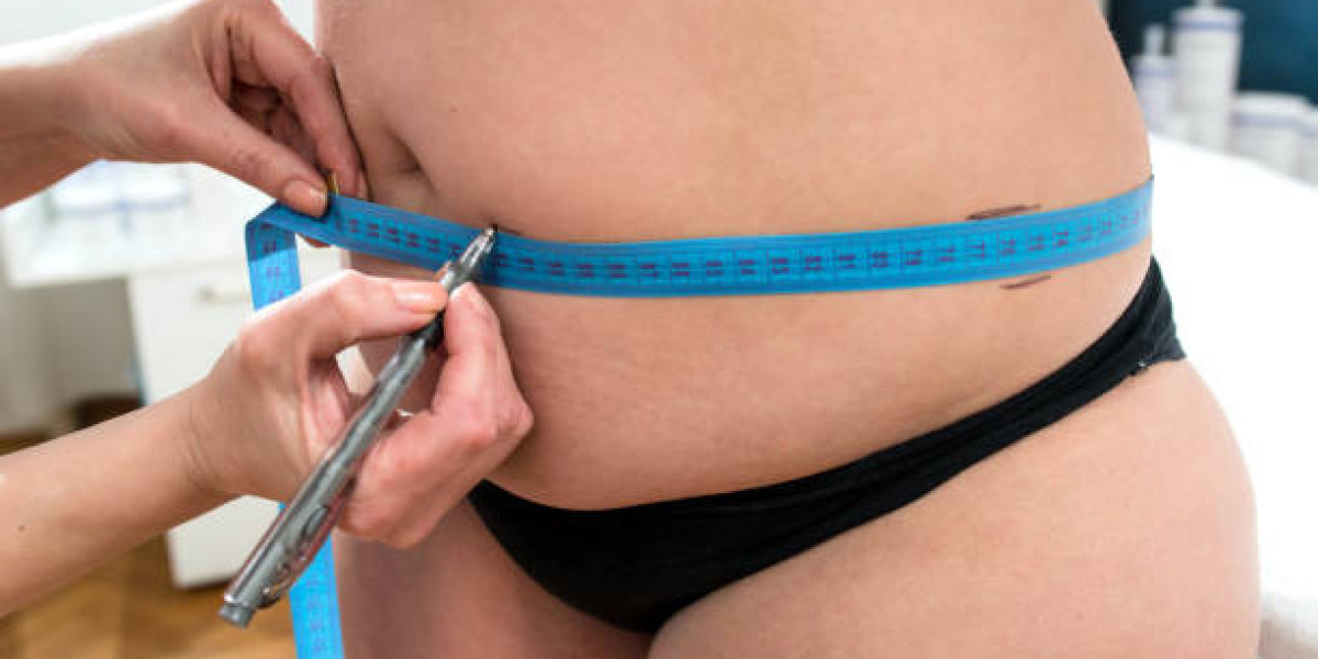 Liposuction in Dubai for Lipedema: Expert Medical Care