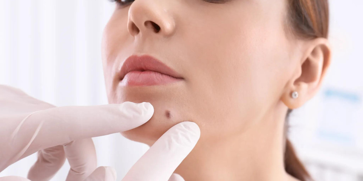Why Is Mole Removal in Dubai in High Demand?
