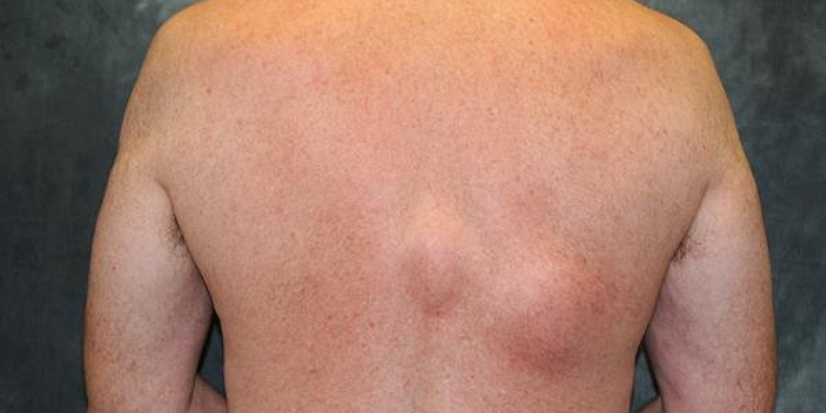 Lipoma Treatment and How to Choose the Right Option