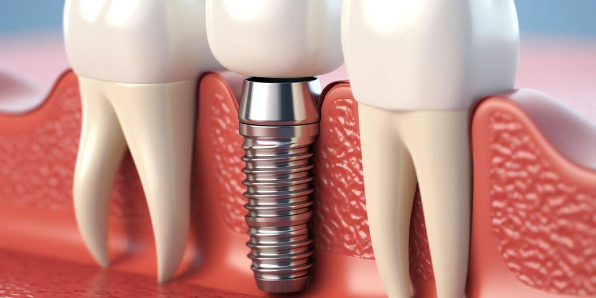What Happens After 20 Years of Dental Implants?