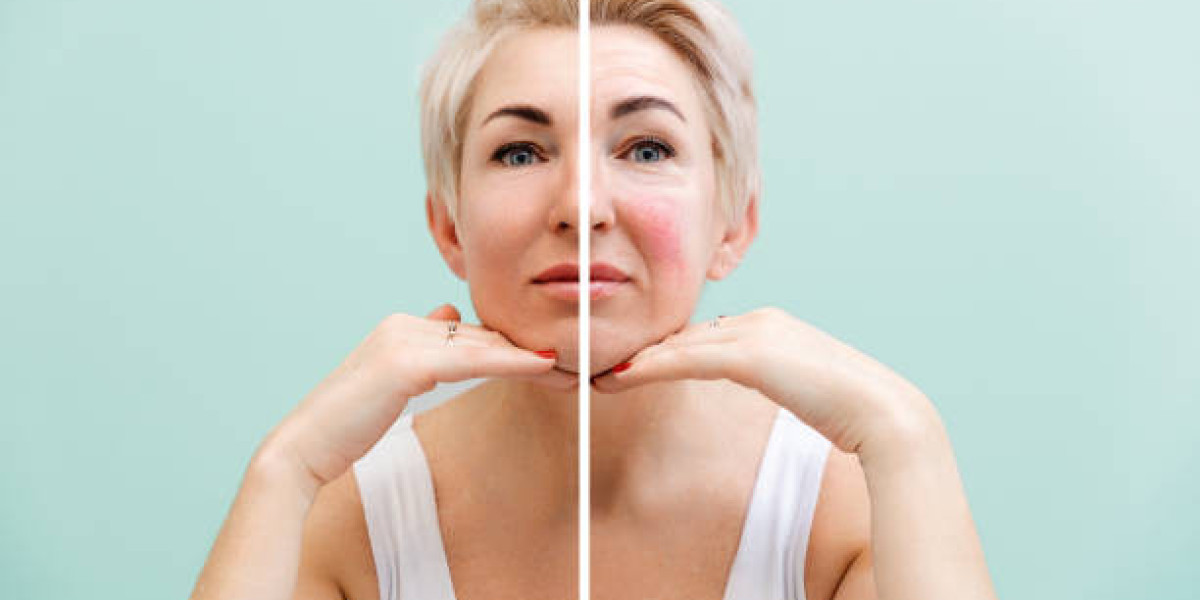 Facial Capillary Treatment in Dubai for Athletes and Gym-Goers