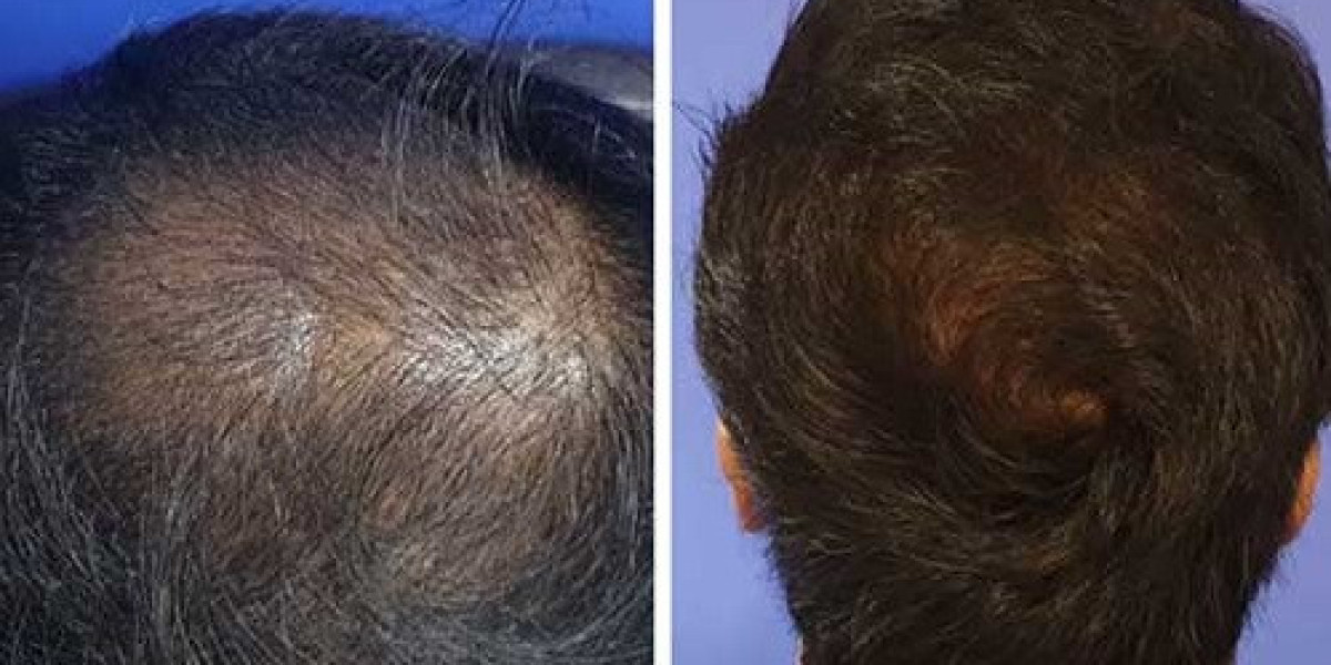 احجز استشارتك اليوم: ابدأ رحلتك لزراعة الشعر في دبي