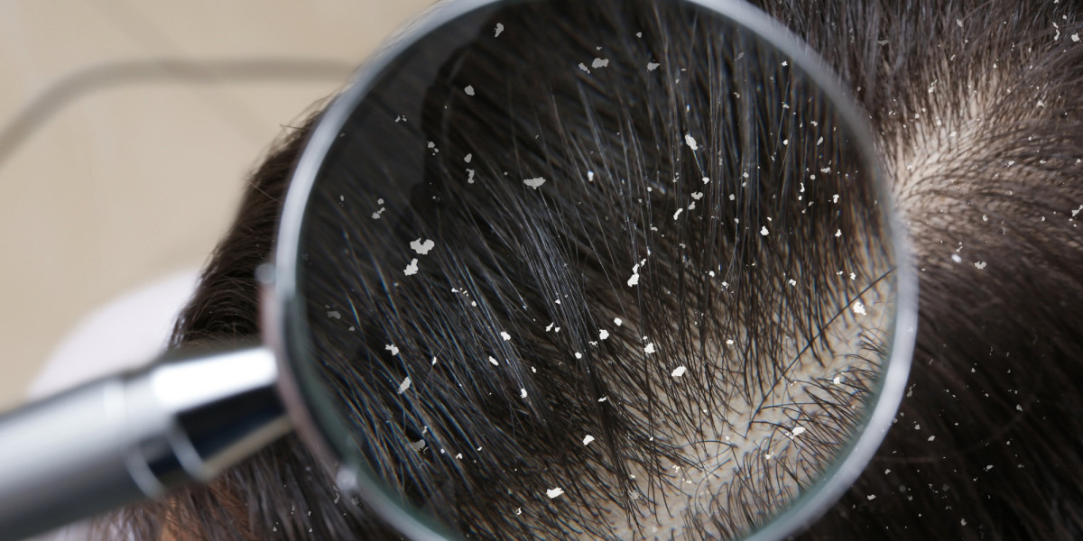 Complete Guide for Best Anti-Dandruff Shampoo & Hair Care