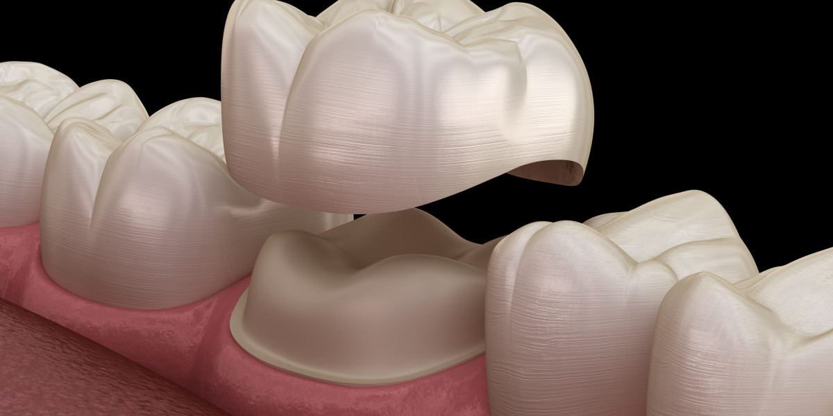 Dental Crowns and Bridges Unlock Brilliant Smile Makeovers With Ease