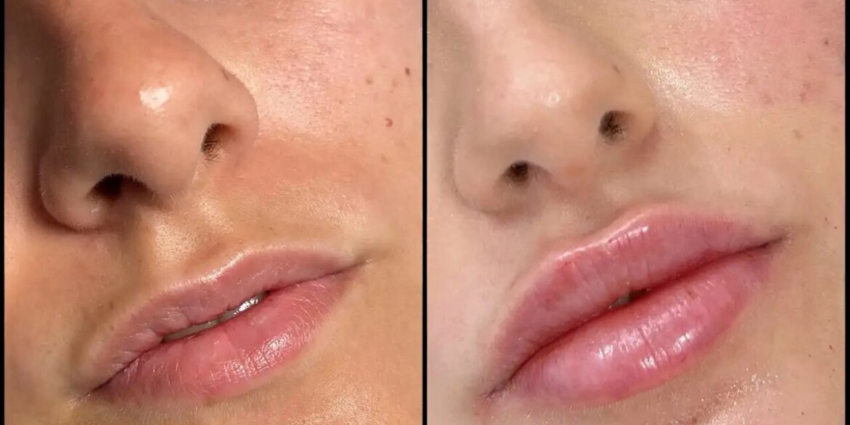 Fillers Treatments in Dubai for Non-Surgical Beauty Enhancement