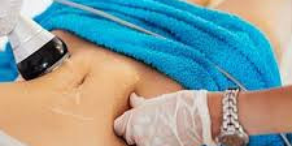How does liposuction support long-term body sculpting outcomes?