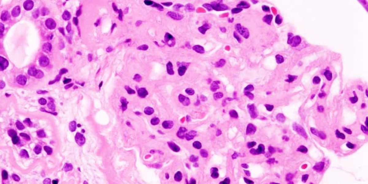 Understanding Kidney Disease Risks and Treatment Options Today