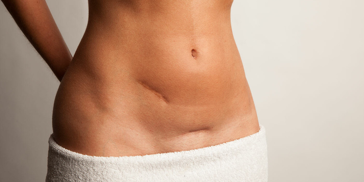 Choosing a Qualified Specialist for Scar Camouflage in Dubai