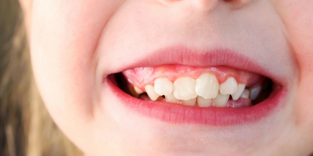 Overlapping Teeth Treatment: Modern Dental Care for a Healthy, Straight Smile