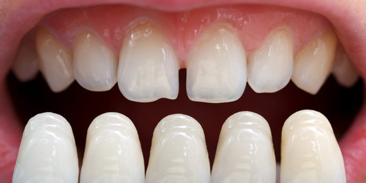 Why More Homeowners and Professionals Are Choosing Veneers Newport Beach for a Confident Smile