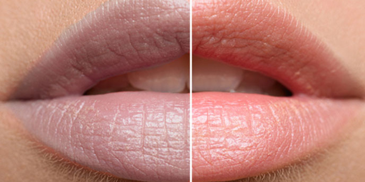 Can Smoker Lips Treatment in Islamabad Improve Your Confidence?