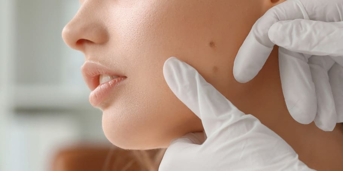 When Can You Plan Mole Removal in Dubai?