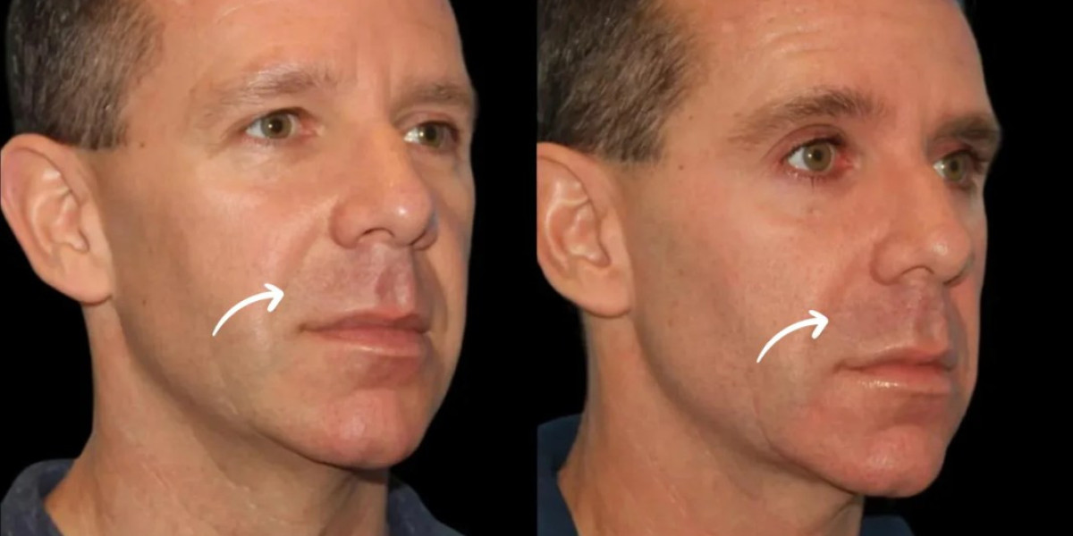 Best Aesthetic Clinic in Dubai for Sculptra Fillers Male Chin Width