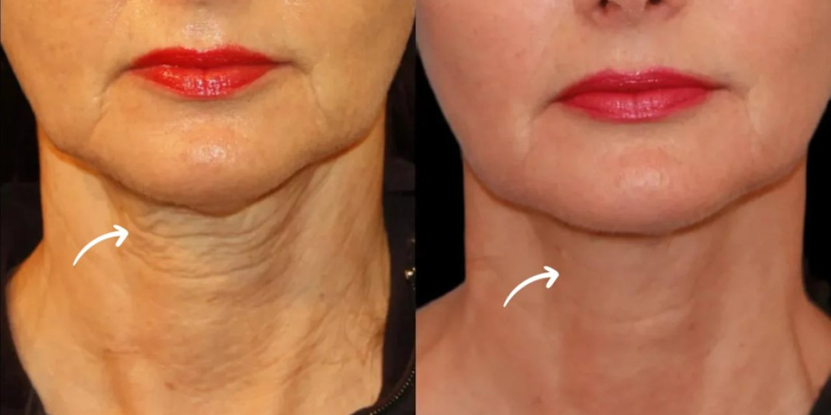 Sculptra Fillers in Dubai for Age-Related Volume Loss